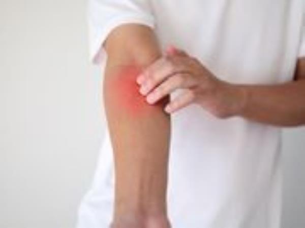 皮肤问题可能是风湿病的第一个征兆
