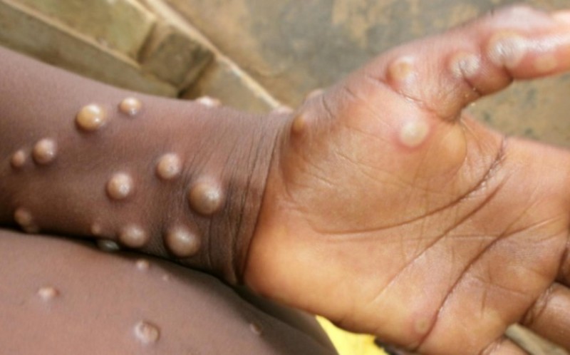 巴基斯坦报告2024年首例麻疹病例