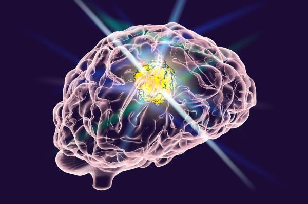 增强免疫系统：加州大学洛杉矶分校的开创性疫苗有望对抗致命的脑癌