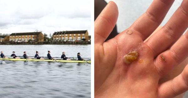十几岁的赛艇运动员在泰晤士河污水引起严重感染后接受静脉注射