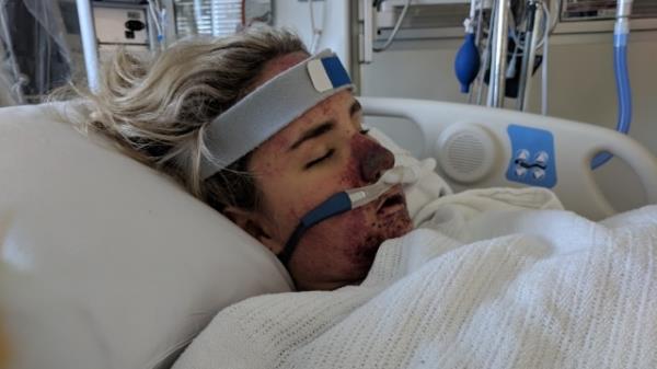 差点死于脑膜炎球菌病的布里斯班少年的母亲敦促父母给孩子接种疫苗