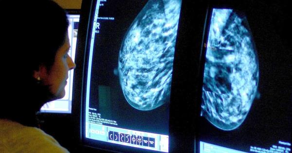 到2034年，乳腺癌将给英国经济造成36亿英镑的损失