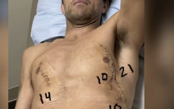 Injuries sustained by Caleb Adams from the shark attack 