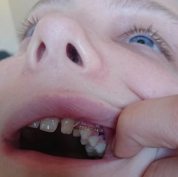 A finger pulls open Ms Monksfield's mouth