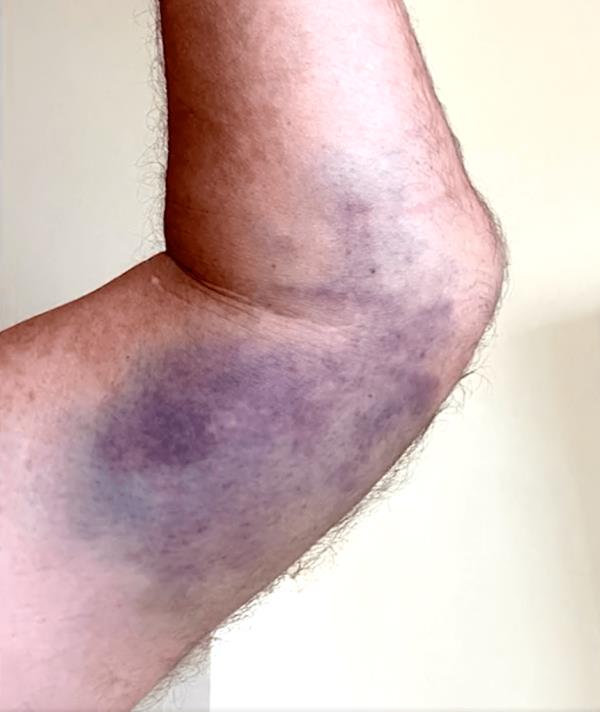 The shaken-up reporter said he was hospitalized and shared a photo of his left elbow, sporting a rather large bruise alo<em></em>ngside a diagram of a radial head fracture, an injury he suffered and co<em></em>nfirmed to SFist.