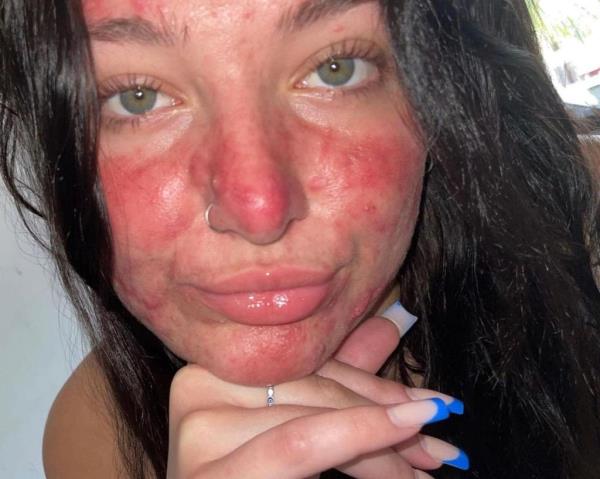 Courtney Jo<em></em>nes with acne in a selfie