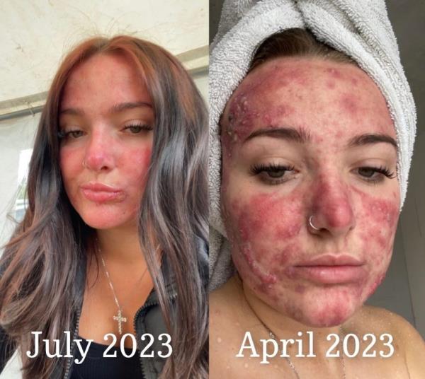Courtney Jo<em></em>nes after and before Accutane
