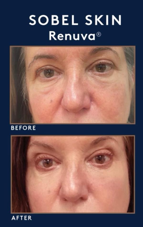 Diane Stasi before and after Renuva injections.