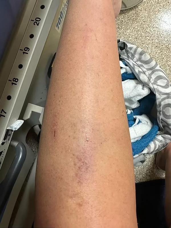 A bruise is pictured on one of the victim's legs