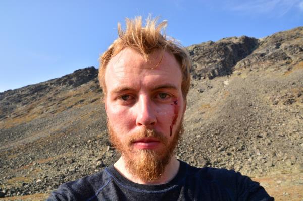 Sture with signs of an attack of the golden eagle that also attacked a toddler in Norway in what an ornithologist says is likely the birdas in the fourth such attack on humans in the past week. The birdas unusual aggression occurred over five days across a vast mountainous area of southern Norway. 