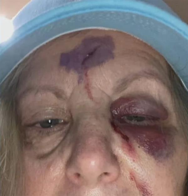Howie Mandel's wife, Terry, with noticeable bruising and lacerations on her forehead and left eye after an accident
