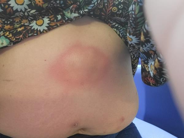 The abscess the size of a small cabbage on Julia Lanni's belly.