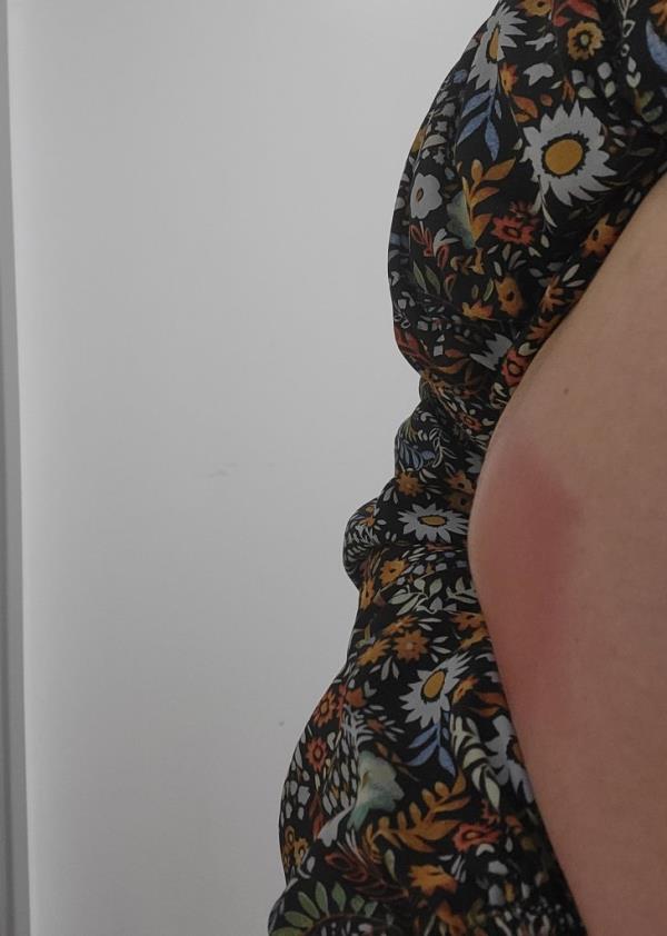 The abscess the size of a small cabbage on Julia Lanni's belly. A mum has been left with low co<em></em>nfidence and a tummy scar after a cabbage-sized abscess erupted on her belly following weight-loss jabs. Julia Lanni, 58, payed around ￡120 for a vial of medicine in a bid to improve her body confidence.. A week after havin<em></em>g 16 injections of fat-dissolving drug Aqualyx, the mum-of-one developed an abscess the size of a small cabbage on her tummy. She was taken to A&E wher<em></em>e she was rushed into theatre.</p>

<p>　　Mum left with scar after abscess erupted on her belly following weight loss drug
