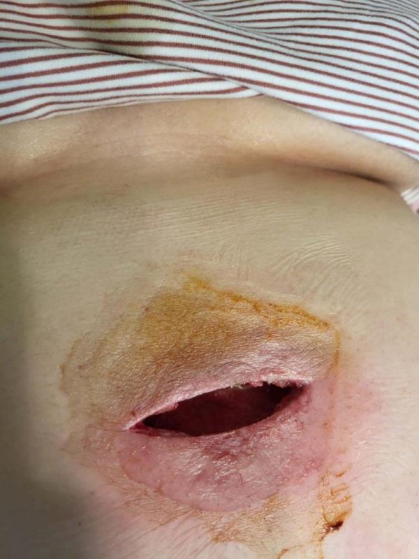 The hole in Julia Lanni's belly, 7cm deep and 10 across