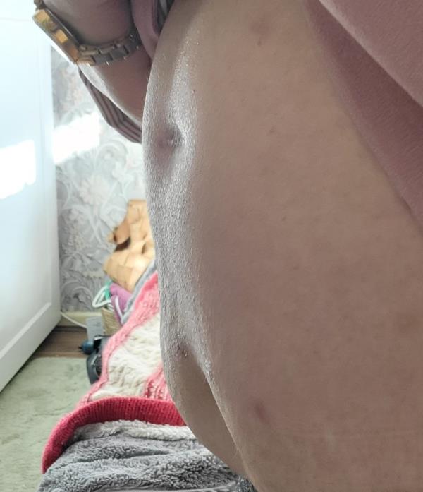 The four-centimetre scar on Julia Lanni's belly. A mum has been left with low co<em></em>nfidence and a tummy scar after a cabbage-sized abscess erupted on her belly following weight-loss jabs. Julia Lanni, 58, payed around ￡120 for a vial of medicine in a bid to improve her body confidence.. A week after havin<em></em>g 16 injections of fat-dissolving drug Aqualyx, the mum-of-one developed an abscess the size of a small cabbage on her tummy. She was taken to A&E wher<em></em>e she was rushed into theatre.</p>

<p>　　Mum left with scar after abscess erupted on her belly following weight loss drug
