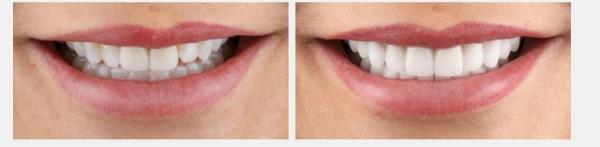 Kristi Noem teeth