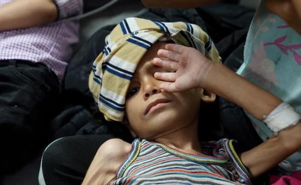 Over 8,000 Children Aged Under 5 Treated For Acute Malnutrition In Gaza: WHO Over 8,000 Children Aged Under 5 Treated For Acute Malnutrition In Gaza: WHO